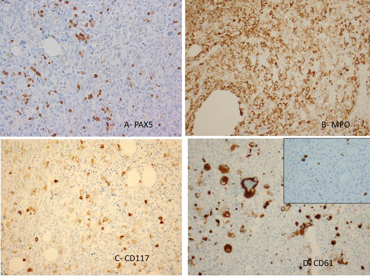 A- PAX5 highlights a subset of the blasts are positive.  B- MPO is diffusely positive.  C- CD117 highlights the blasts that are clustering.  D- Stains the megakaryocytes that are atypical. CD3 is negative (inset).